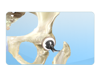 Total Hip Replacement - Bradley K. Vaughn, MD, FACS - Adult Joint Replacement Surgeon