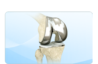 Total Knee Replacement - Bradley K. Vaughn, MD, FACS - Adult Joint Replacement Surgeon
